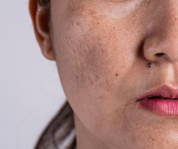 Understanding Melasma During Pregnancy: Causes, Prevention, and Treatment