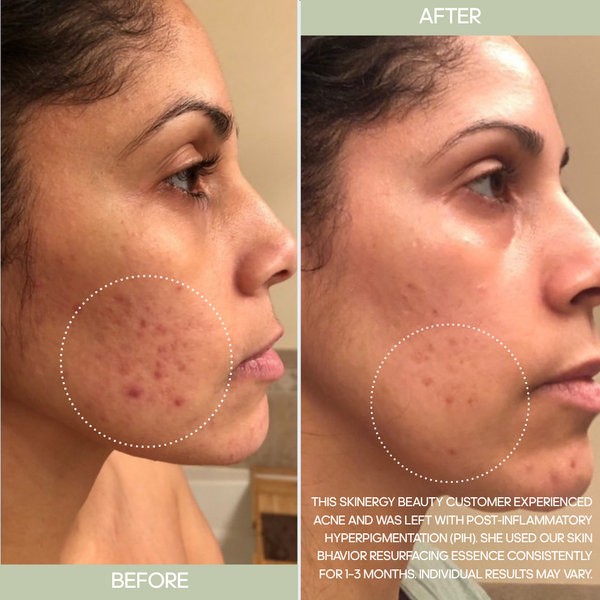 Acne Control Duo